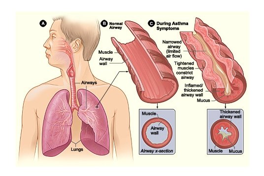 asthma treatment in hindi
